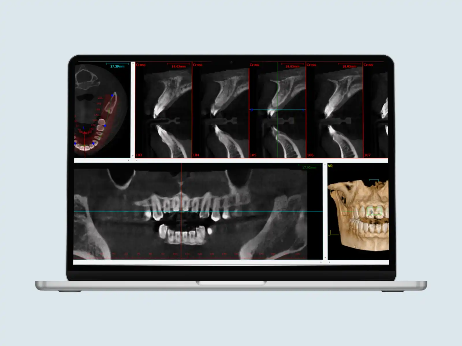 3D CBCT digital assessment for dental implants at 32 Intact Bilaspur