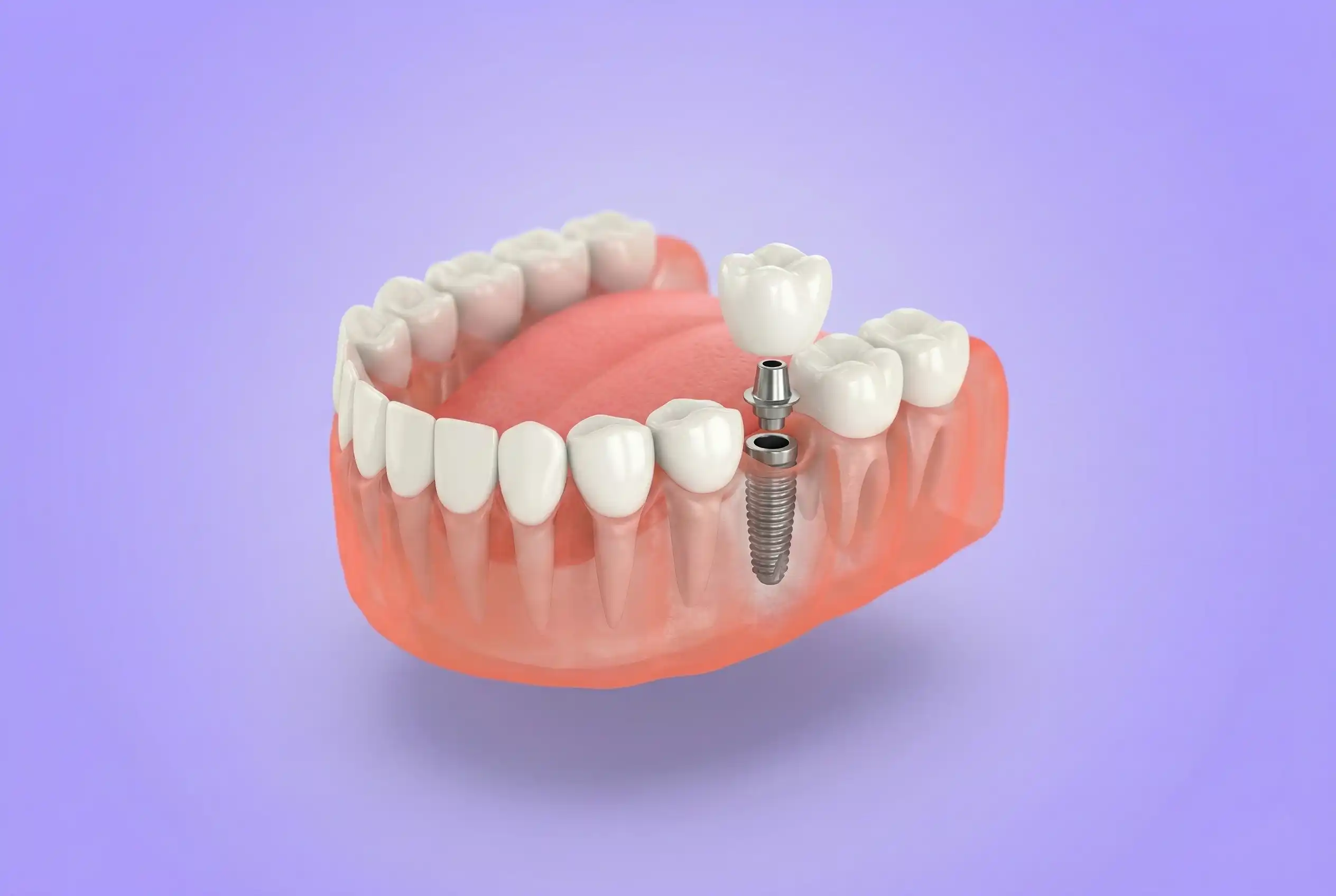 After implant treatment at 32 Intact Bilaspur