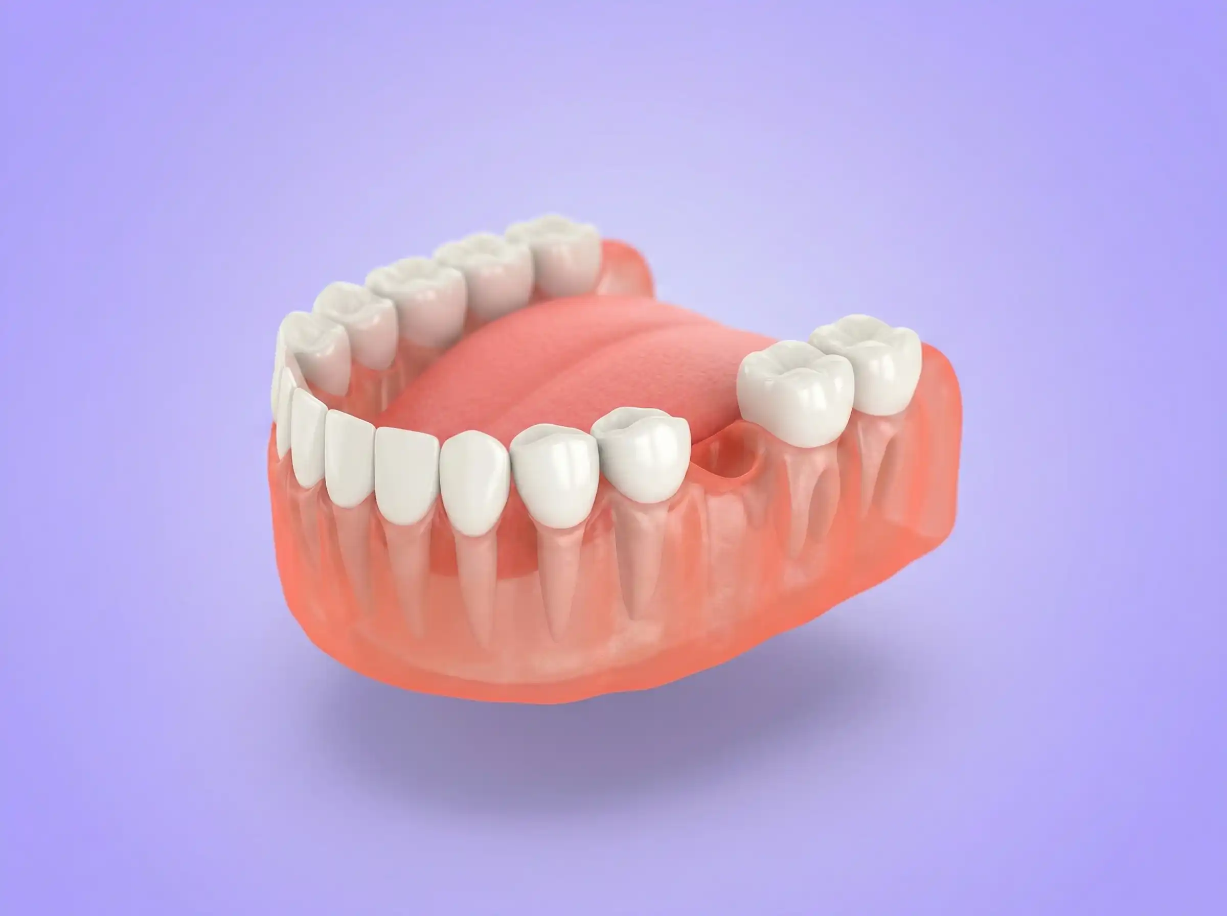 Before implant treatment at 32 Intact Bilaspur