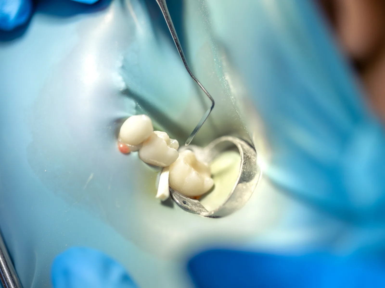 Single-Visit Resolution of Severe Dental Abscesses