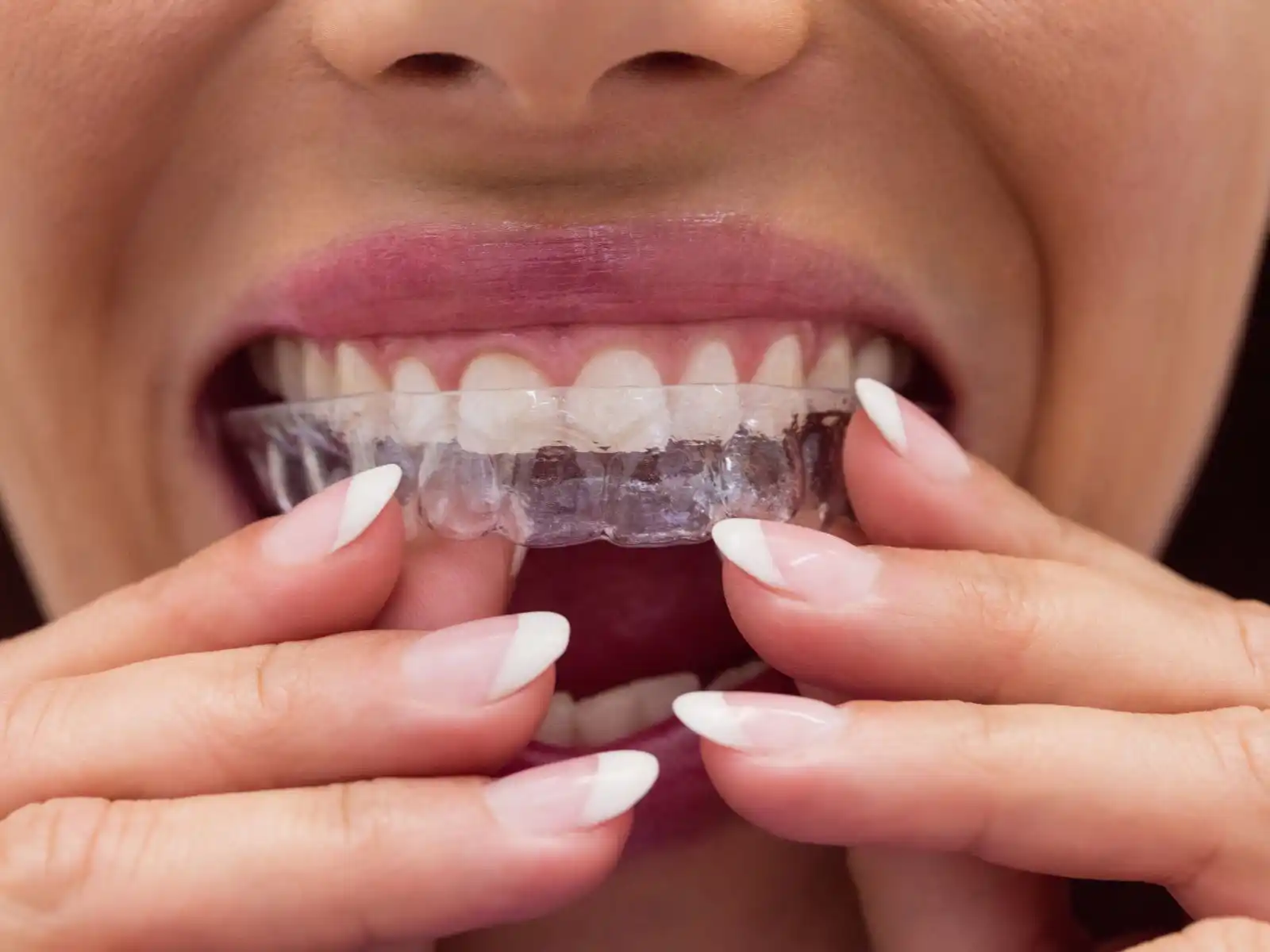 Aligner Delivery - 32 Intact