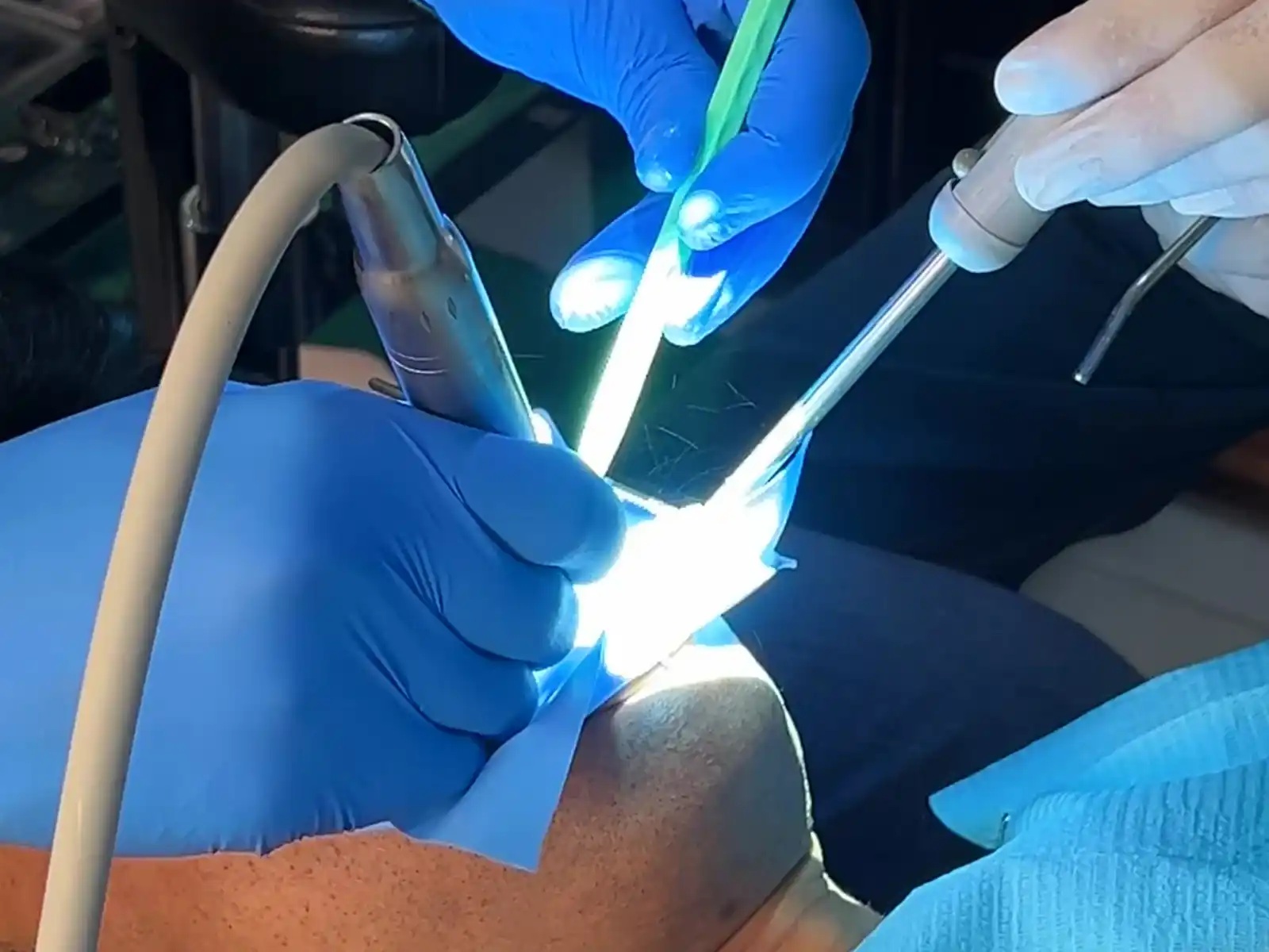 Expert endodontist performing microscopic root canal cleaning at 32 Intact Bilaspur