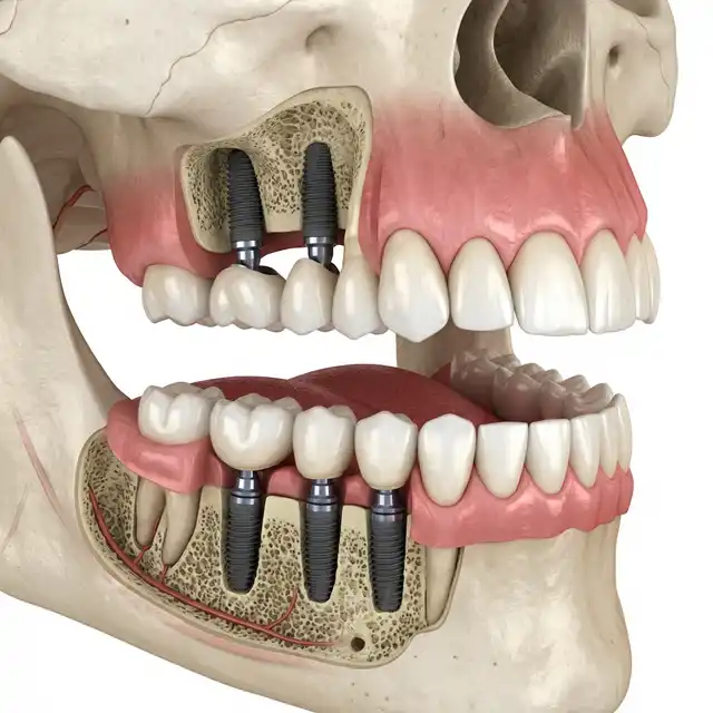 Multiple missing teeth after bridge restoration