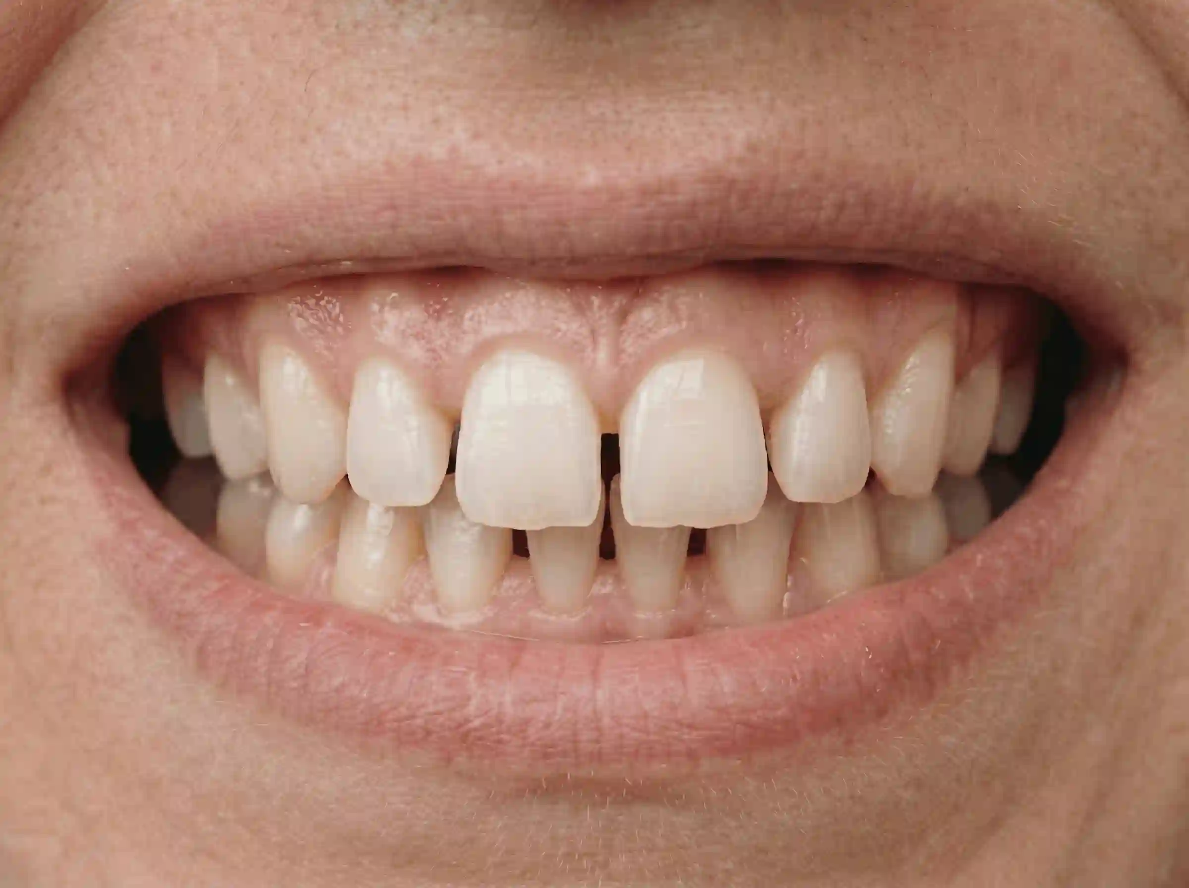 Before: deep bite and overbite correction case at 32 Intact Bilaspur